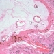 Anterior Hyaloid Fibrovascular Proliferation